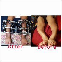 Ring Fixators for Arshaan, 2015