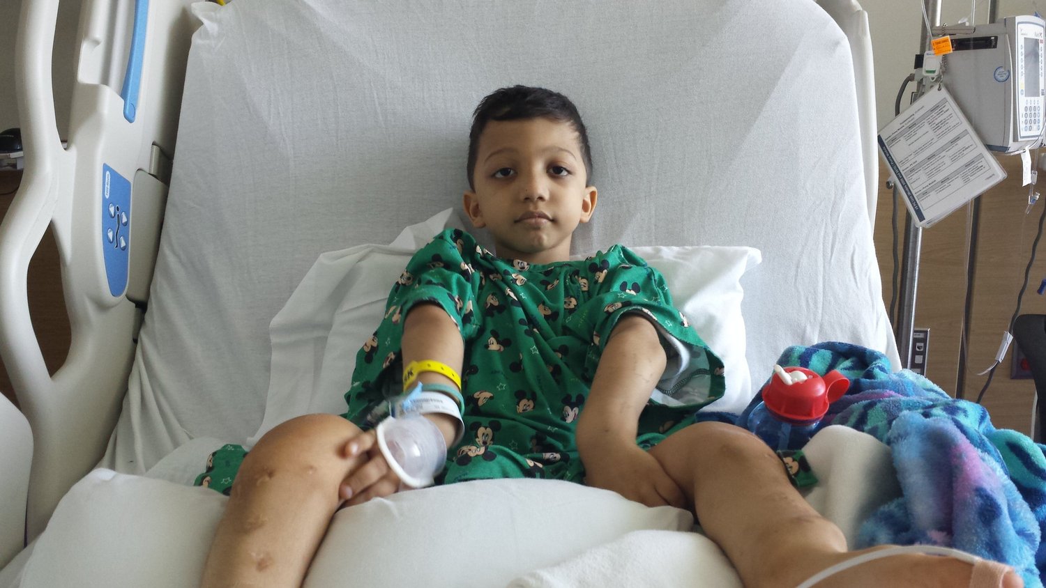 Femurs rodded, A I Dupont Hospital for Children, Delaware