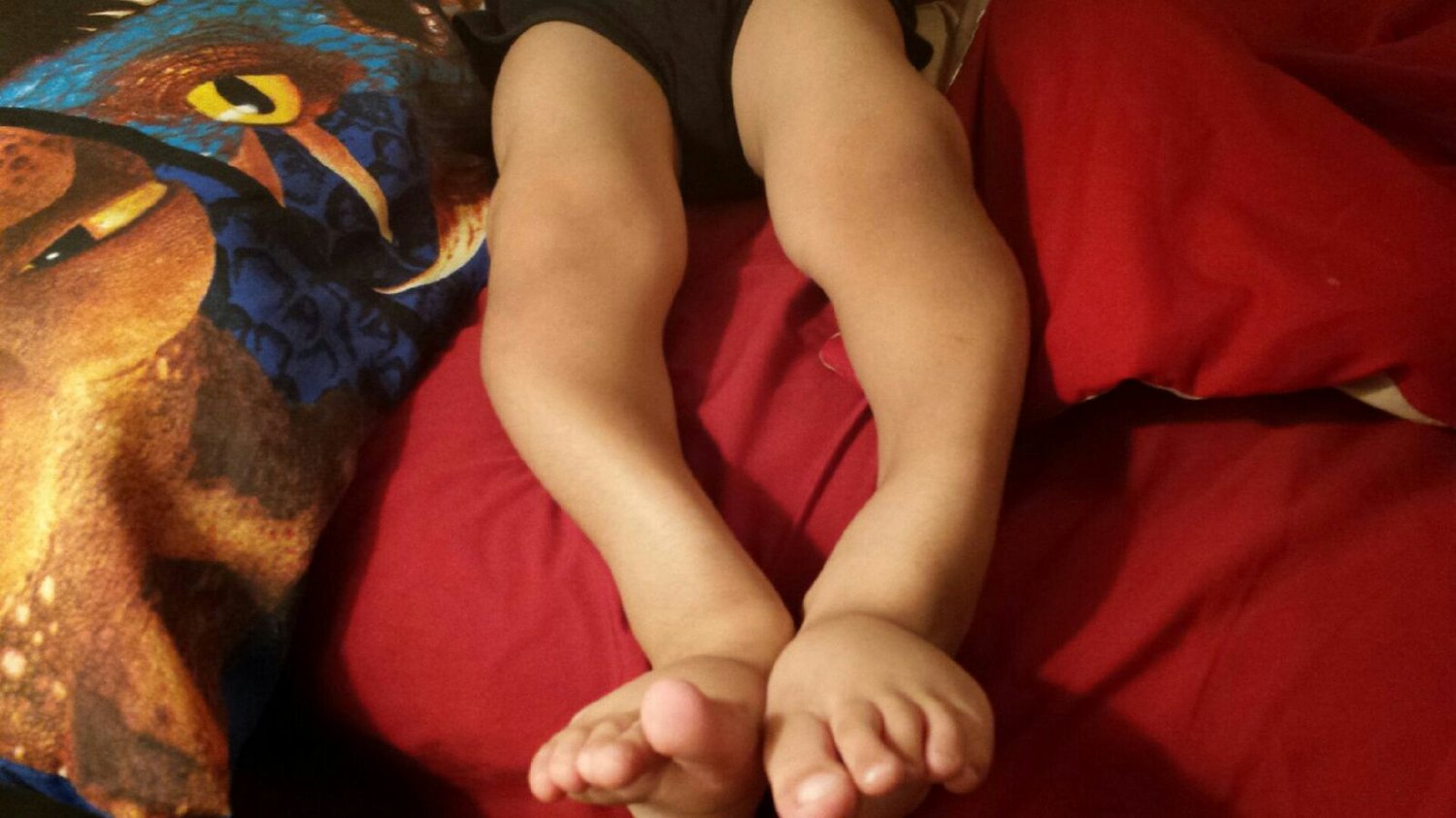 Arshaan's legs pre-surgery