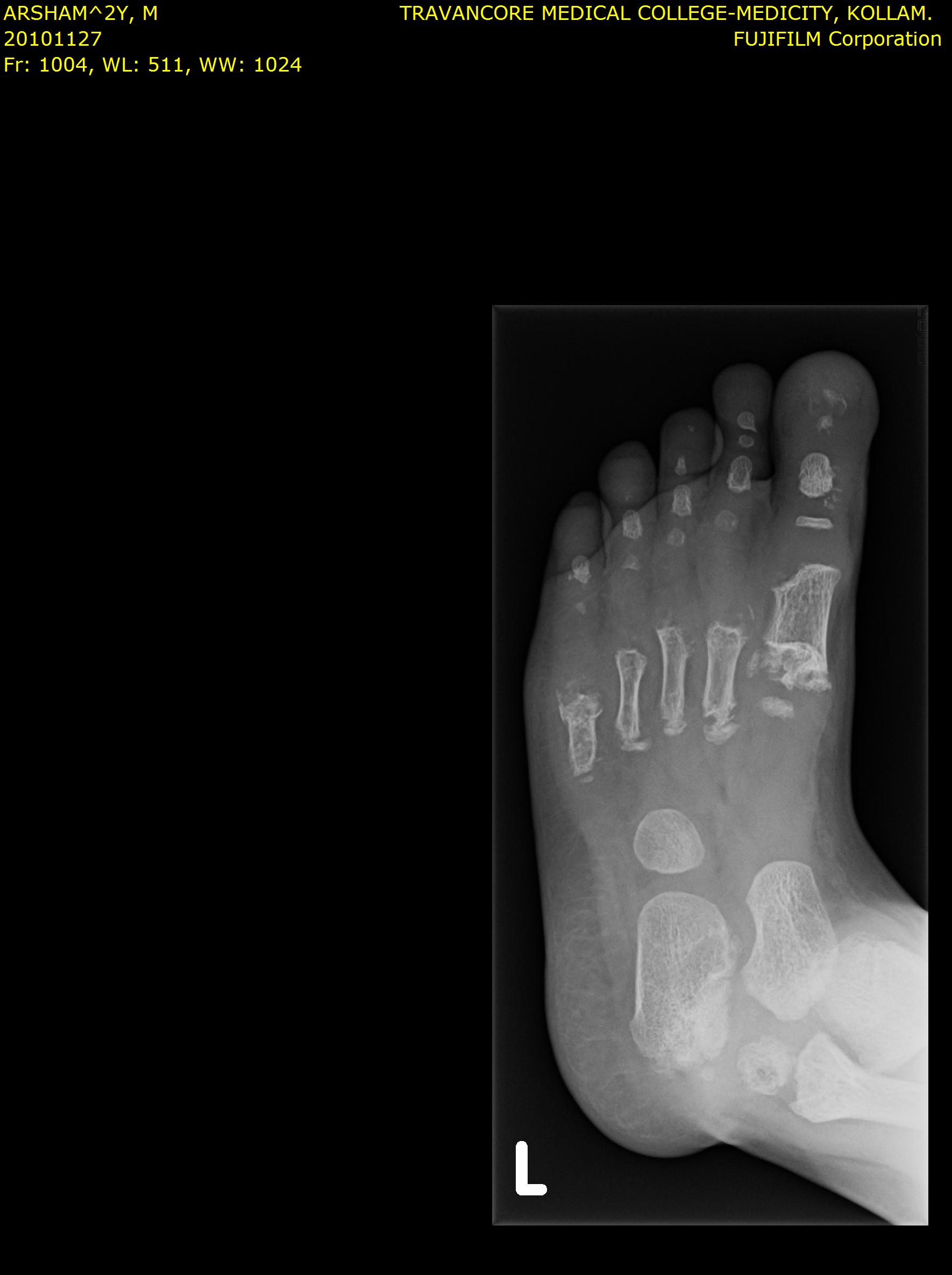 Foot X-ray showing bone changes
