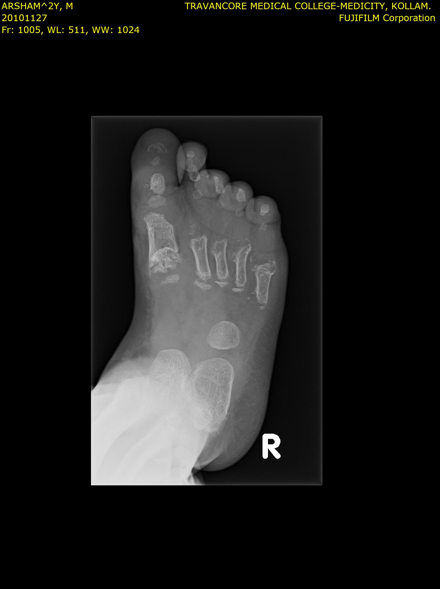 Additional foot X-ray
