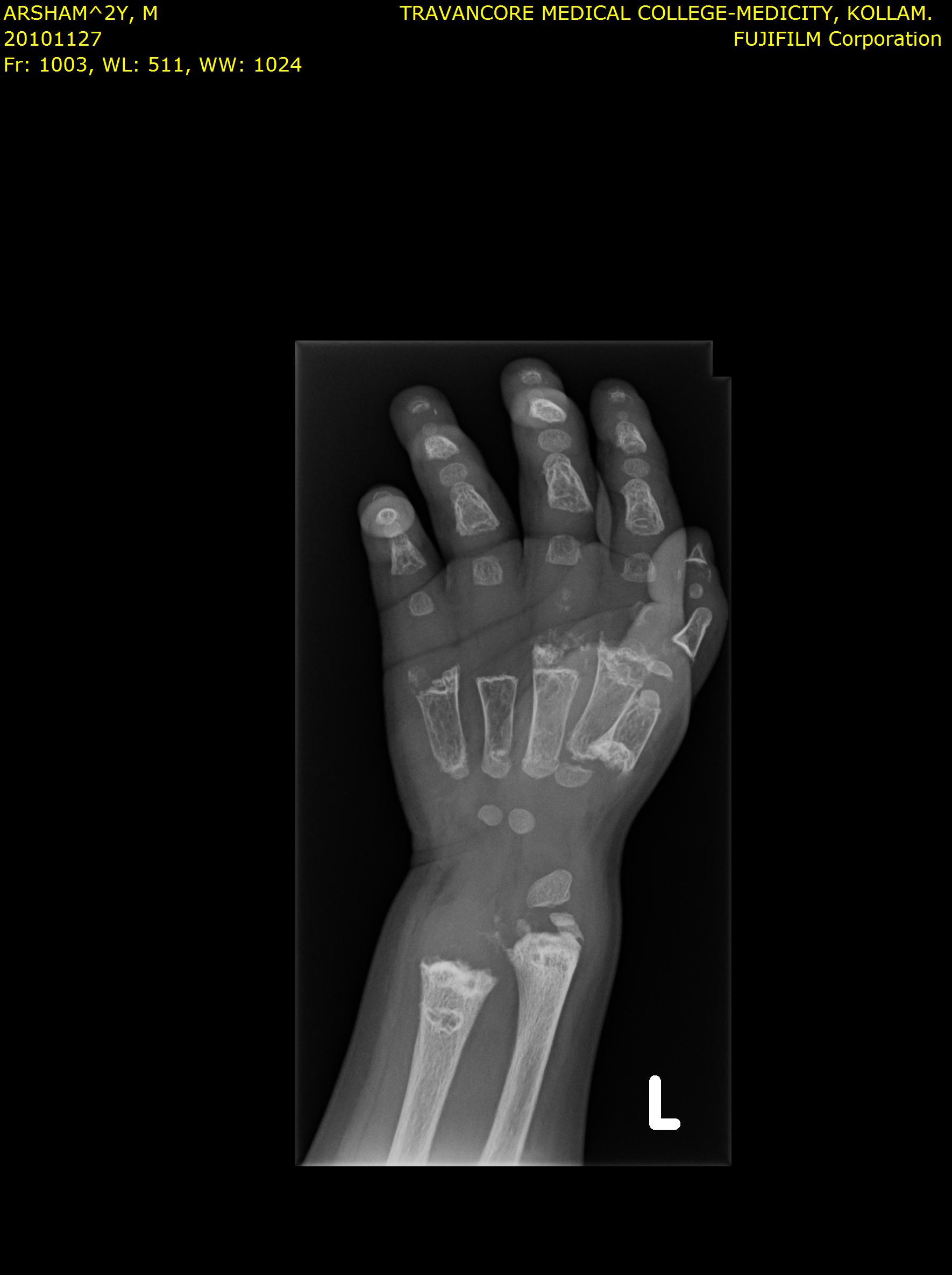Additional hand X-ray