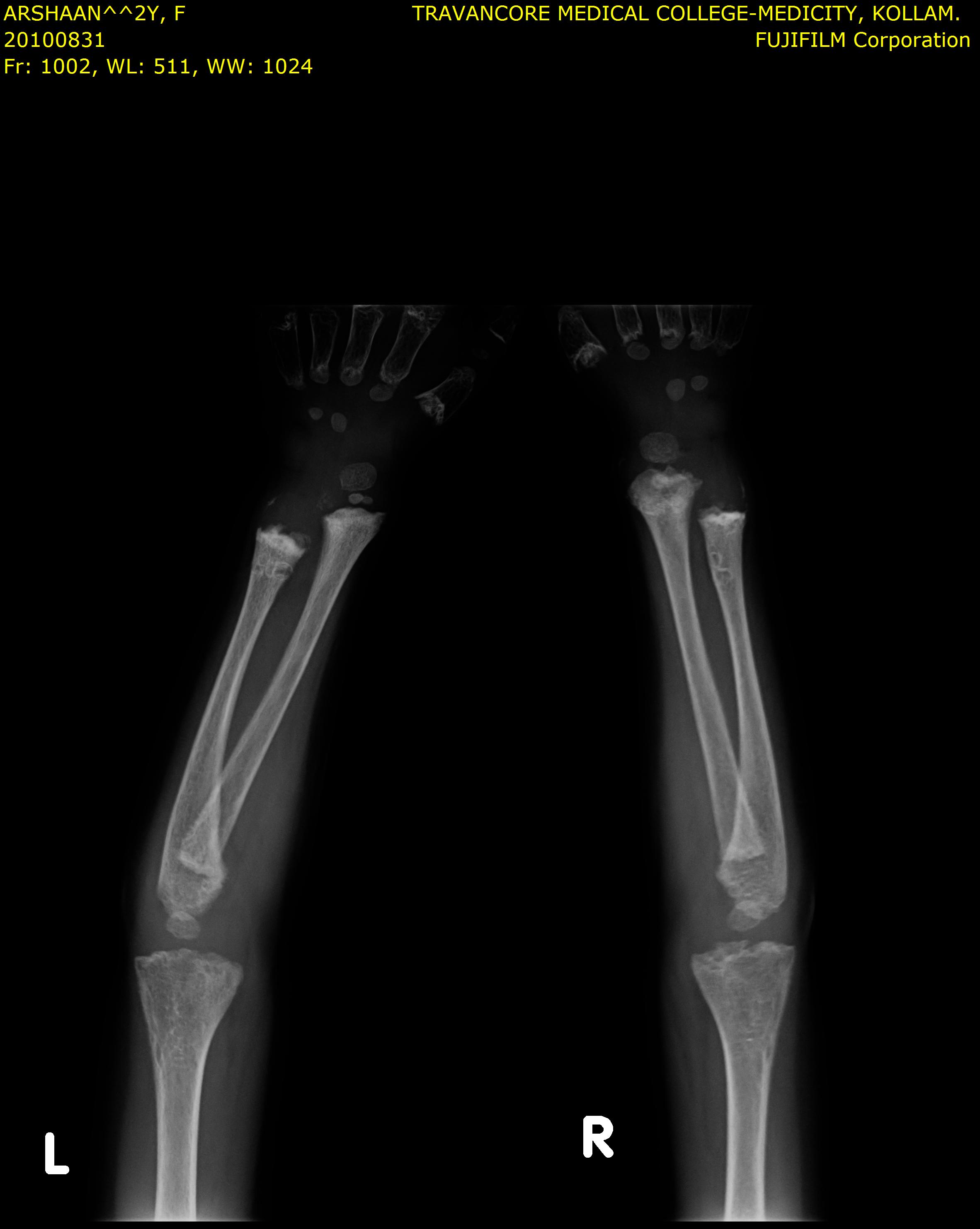 Hands X-ray showing short distal phalanges